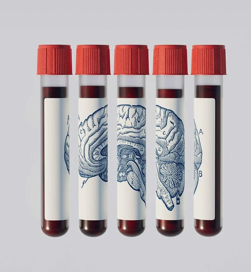 Μπορεί μια εξέταση αίματος να δείξει αν θα εμφανίσετε άνοια δεκαετίες πριν;