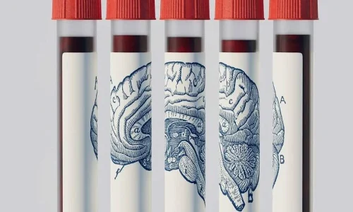 Μπορεί μια εξέταση αίματος να δείξει αν θα εμφανίσετε άνοια δεκαετίες πριν;