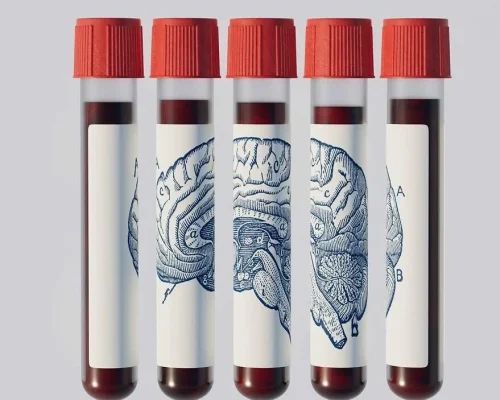 Μπορεί μια εξέταση αίματος να δείξει αν θα εμφανίσετε άνοια δεκαετίες πριν;